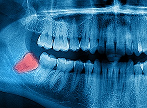 panoramic x-ray of wisdom tooth