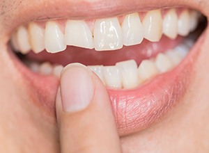 closeup of woman pointing to her broken tooth