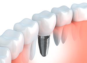 Fairfield restorative dentistry dental implants model
